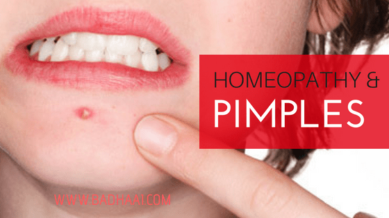 Homeopathic Remedies For Acne And Pimples Homeopathic Remedies For Acne And Pimples